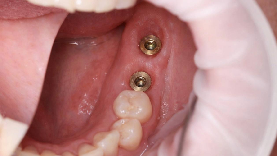 Робота нашого хірурга МИКИТИ АНДРІЙОВИЧА