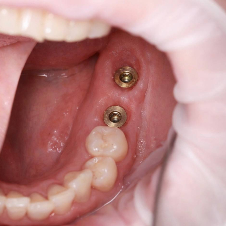 Робота нашого хірурга Нікіти Андрійовича