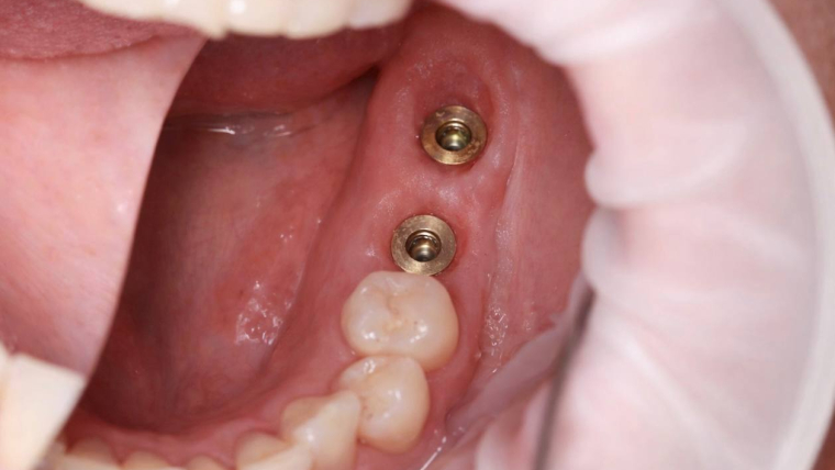 Робота нашого хірурга МИКИТИ АНДРІЙОВИЧА